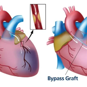 Nursing Diagnosis For Cabg
