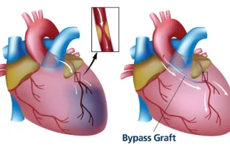 Nursing Diagnosis For Cabg