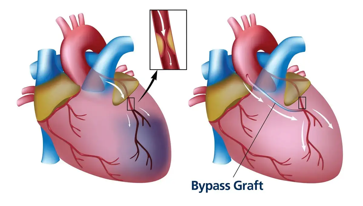 Nursing diagnosis for cabg - Special Mentality