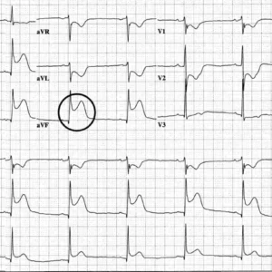 Inferior T Wave Abnormality Is Nonspecific