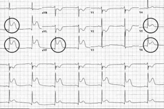 Inferior T Wave Abnormality Is Nonspecific
