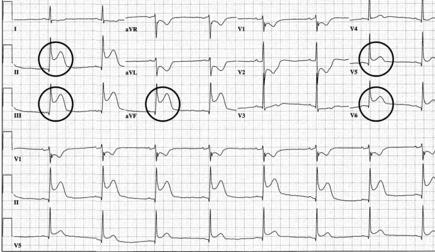 Inferior T Wave Abnormality Is Nonspecific Home Special Mentality